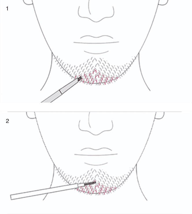 使い方画像 ひげの密度が少なく色ムラが気になる方