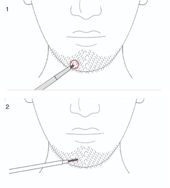 使い方画像 ひげの生え方にムラがあり、抜けが気になる方